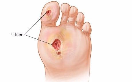 Foot Ulcers