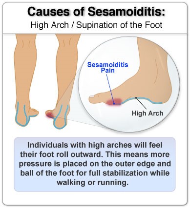 Sesamoiditis