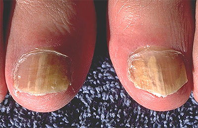 Fungal nail infections