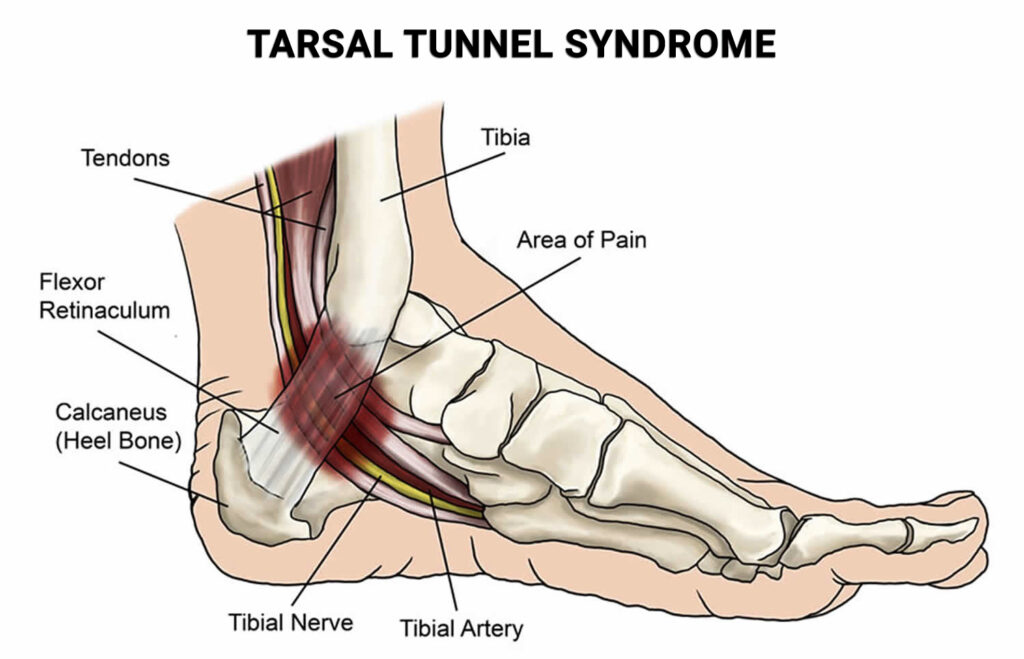 Tarsal Tunnel Syndrome