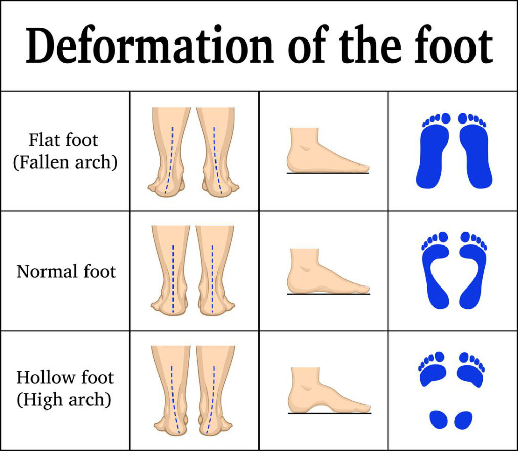 Flat Feet