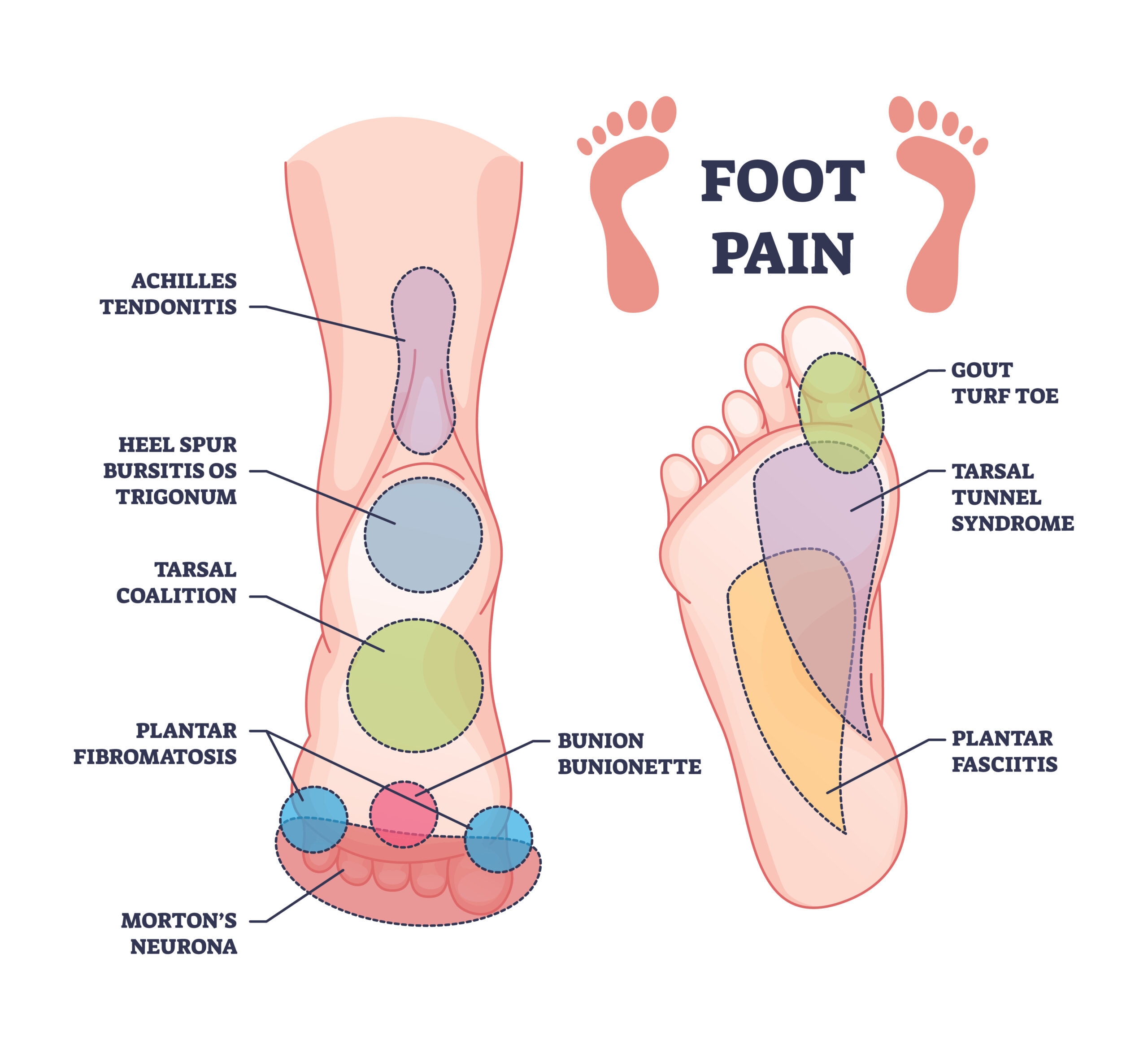 Foot Pain